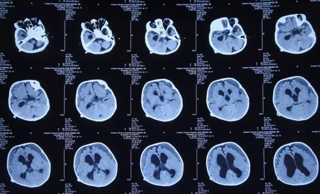 5个月宝宝做ct关于五个月宝宝进行CT检查的相关探讨