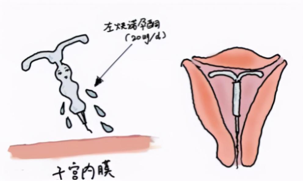 上环半个月内同房出血上环后半个月内同房出血的原因及应对措施